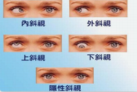 斜视对孩子造成的影响--山东聊城验光配镜培训学校来回答